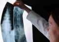 Spinal Cord Injury Attorneys Denver