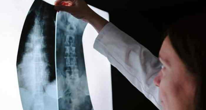 Spinal Cord Injury Attorneys Denver