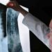 Spinal Cord Injury Attorneys Denver